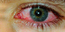 pink eye picture
