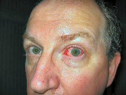 conjunctivitis picture