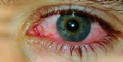 pink eye